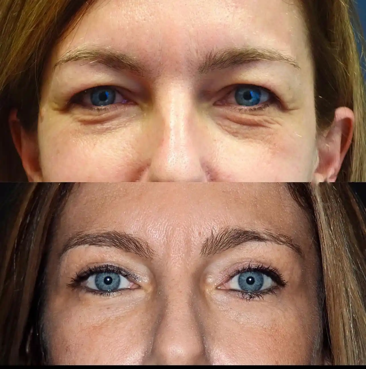 Eye Bag Fat Removal Dubai