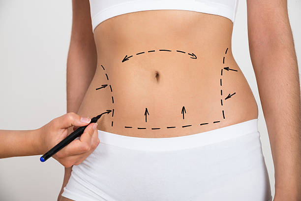 Vaser 4D liposuction in Abu Dhabi