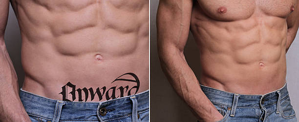 laser tattoo removal in Abu Dhabi