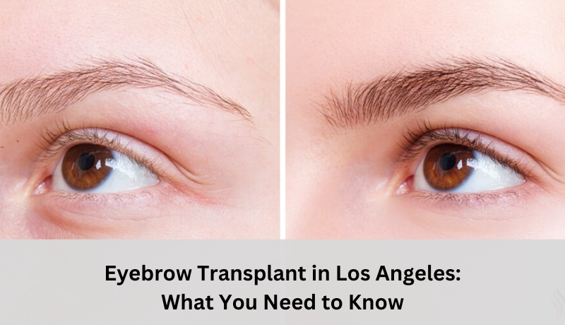 eyebrow transplant Los Angeles