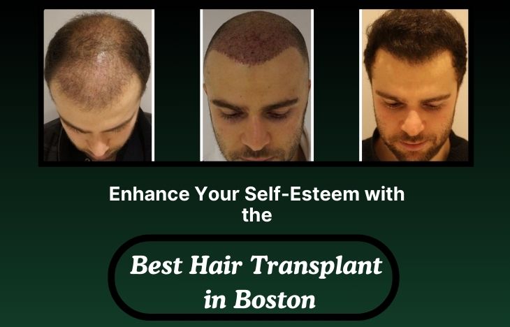 Enhance-Your-Self-Esteem-with-the-Best-Hair-Transplant-in-Boston