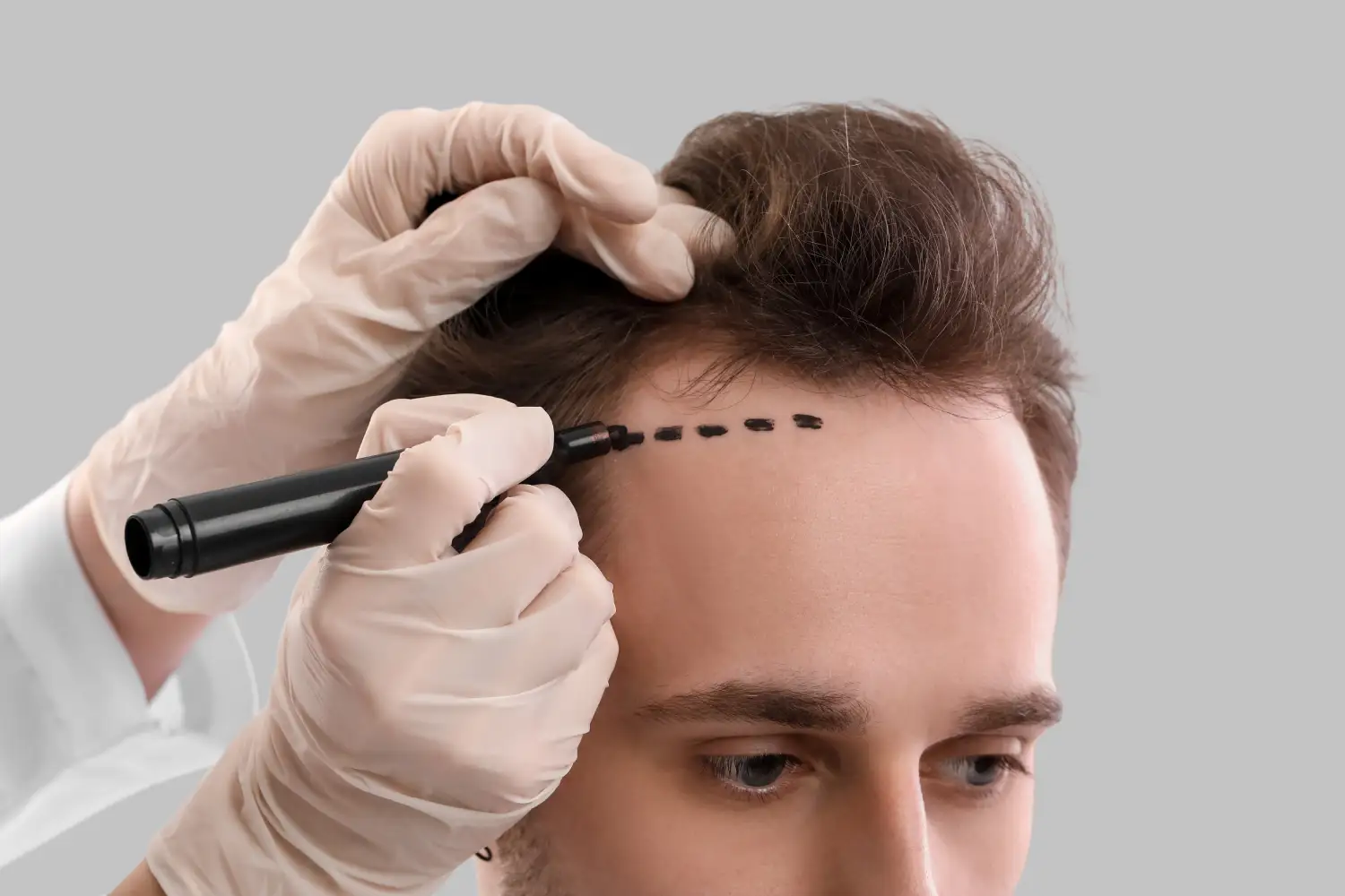 hair transplant Regina