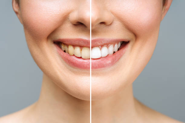 Laser Teeth Whitening in Islamabad: A Bright Solution for a Dazzling Smile