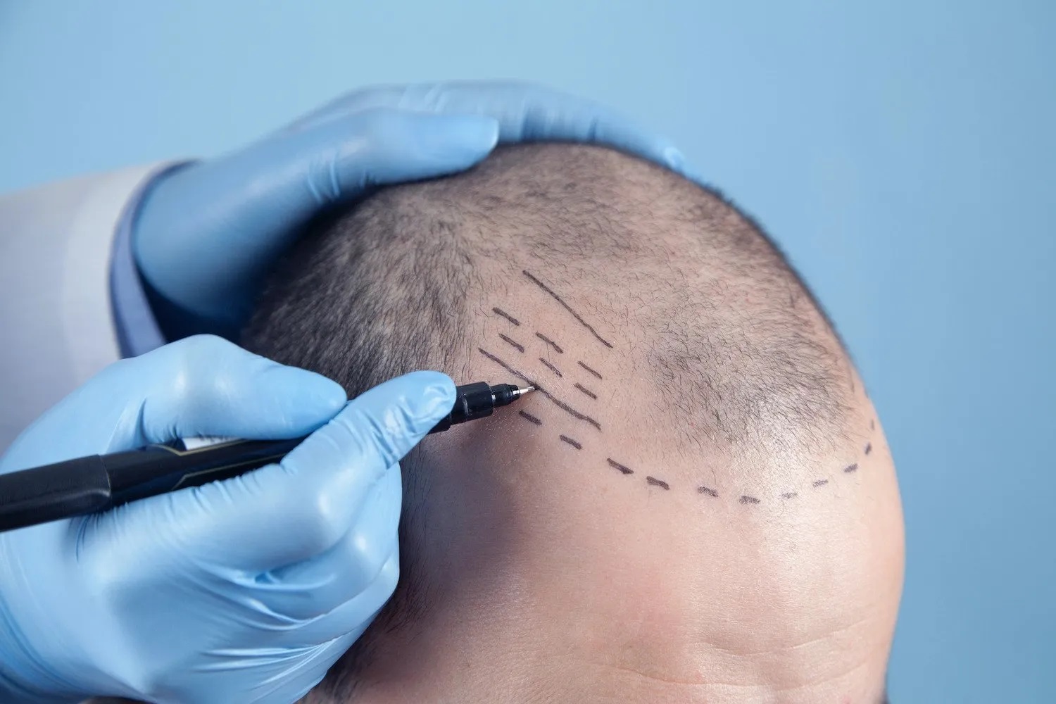 تكلفة زراعة الشعر