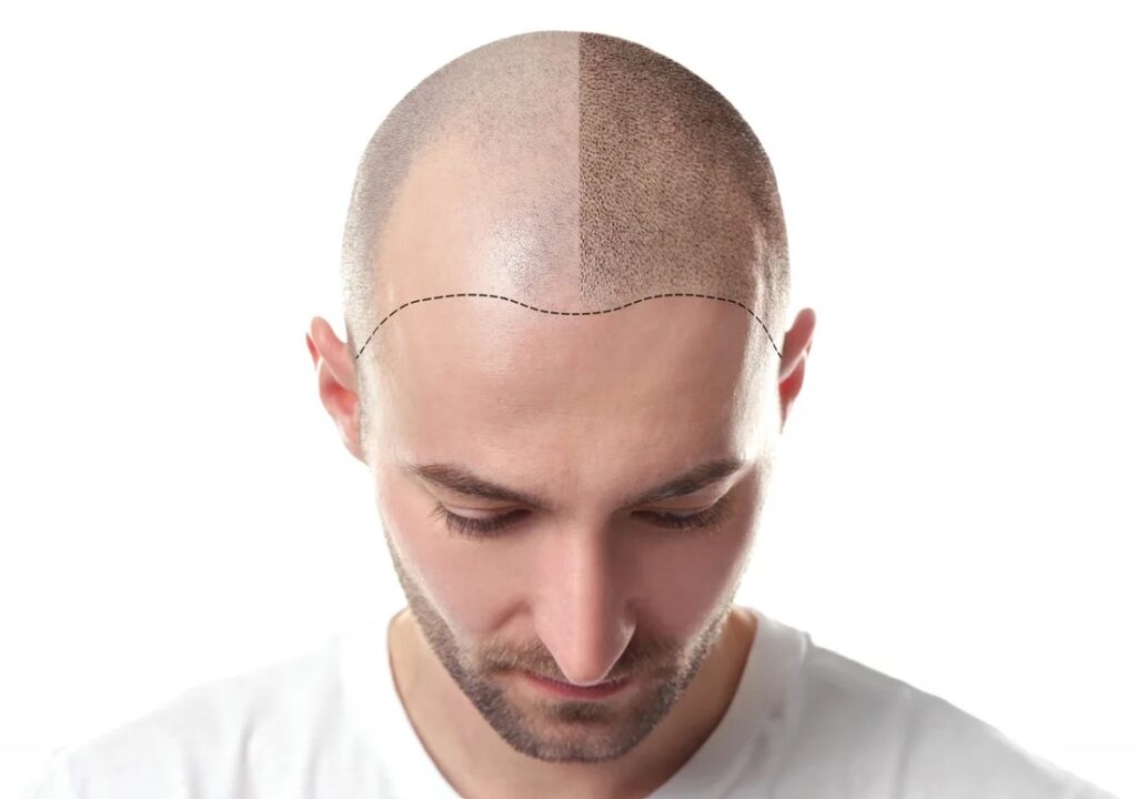 تكلفة زراعة الشعر في دبي