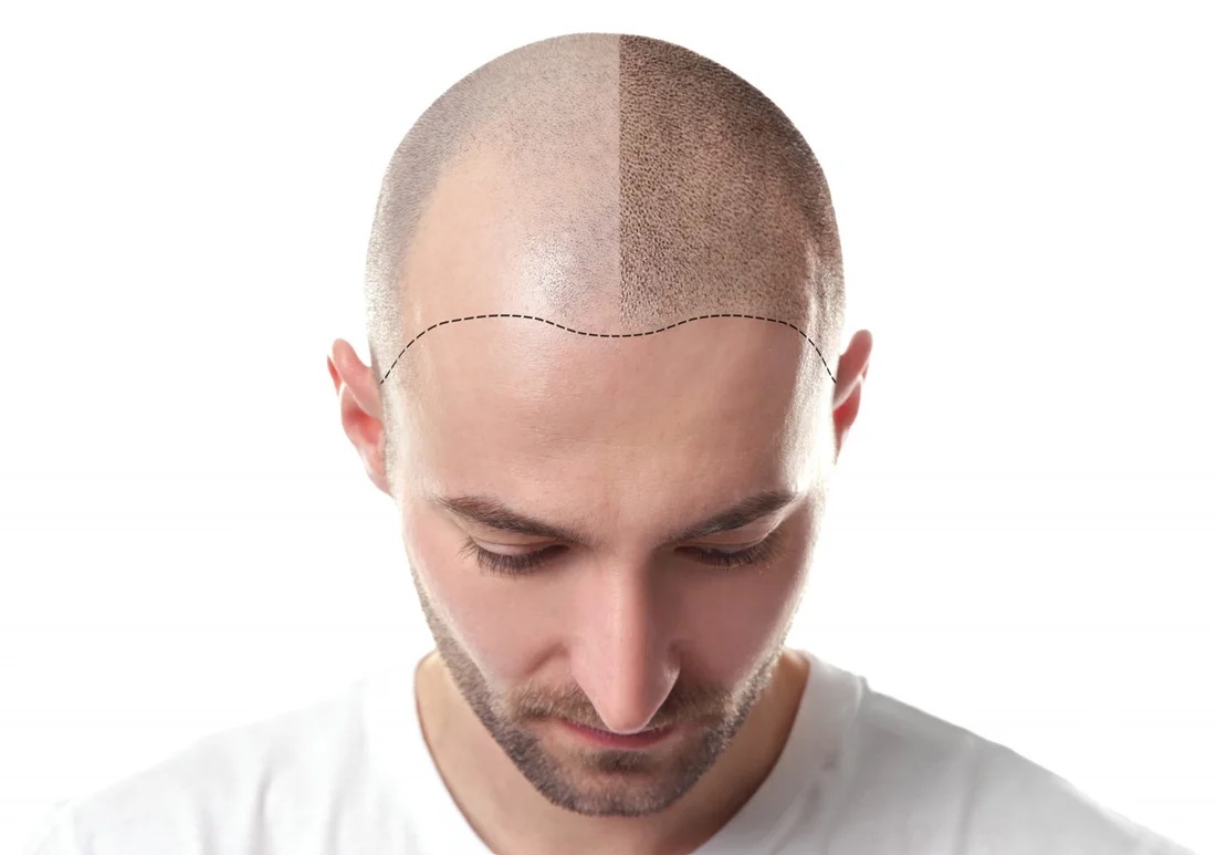 تكلفة زراعة الشعر في دبي