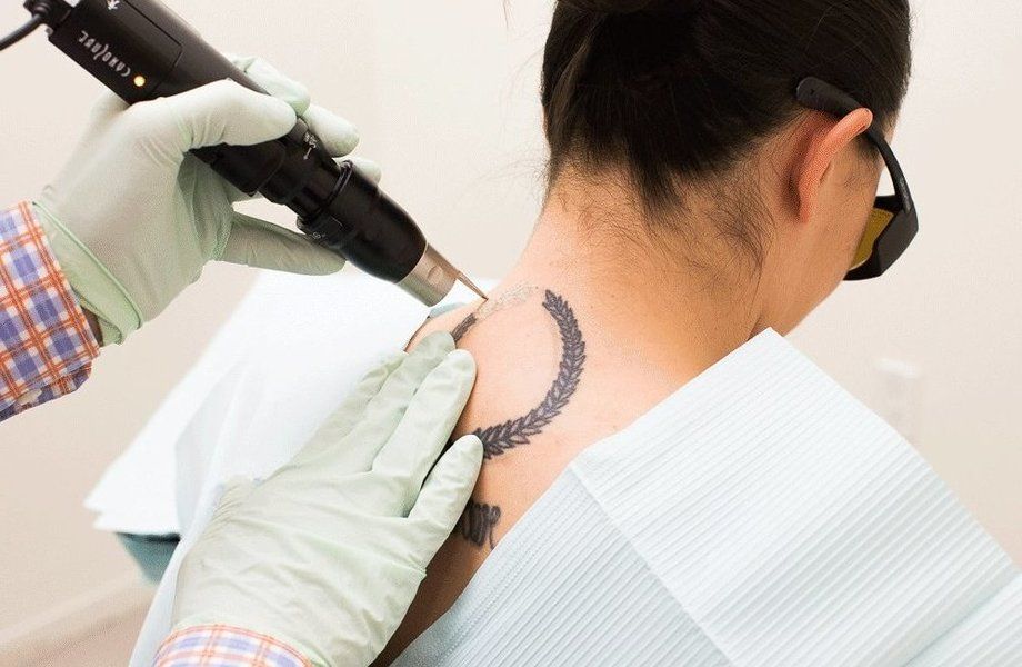 Laser Tattoo Removal in Riyadh