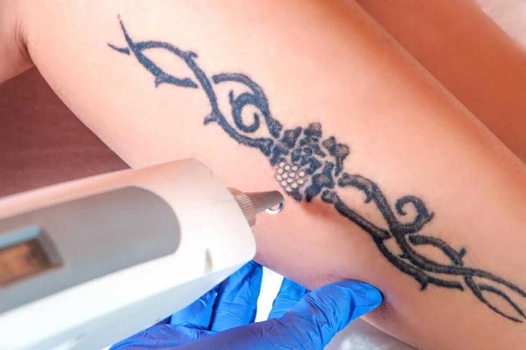 Laser Tattoo Removal in Riyadh