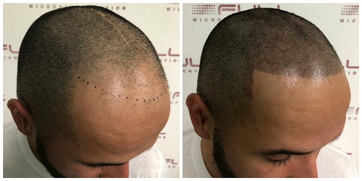 scalp micropigmentation for men