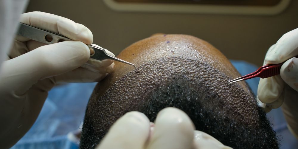 Hair Transplant