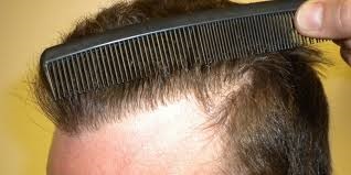 Hair Transplant in Riyadh