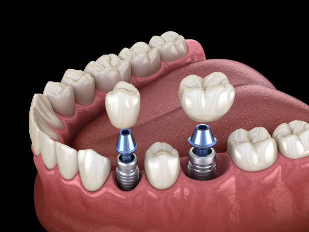 Expert Dental Implant Solutions in a Day