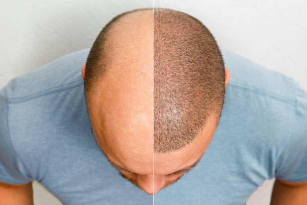 hair transplant