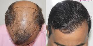 تكلفة زراعة الشعر في دبي