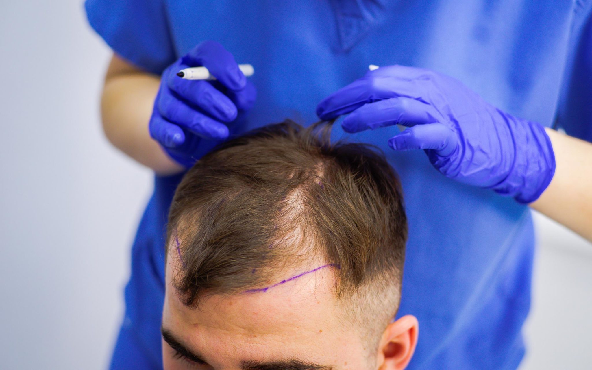 hair transplant cost in Dubai (تكلفة زراعة الشعر في دبي)