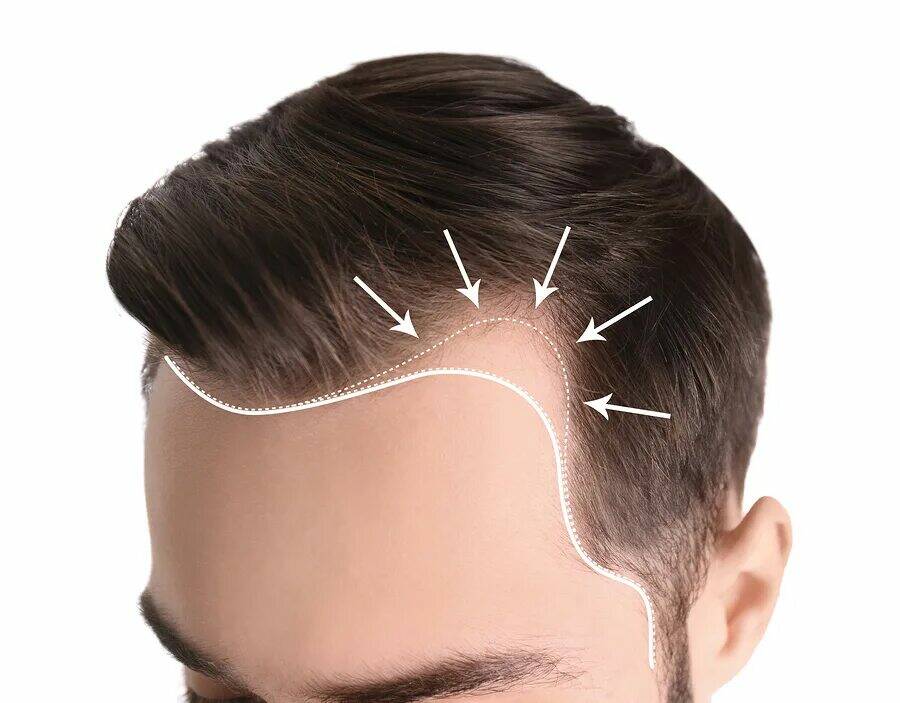 hair transplant in Dubai (زراعة الشعر في دبي)