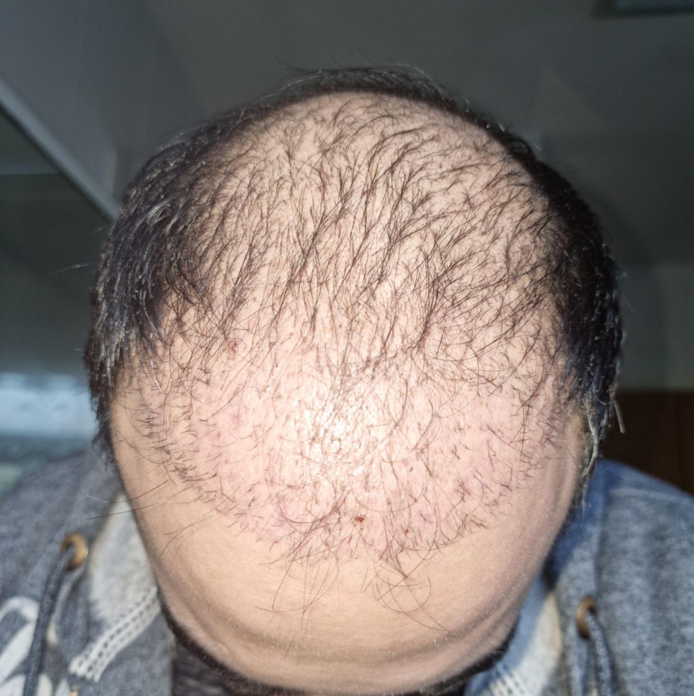 Hair transplant in Dubai