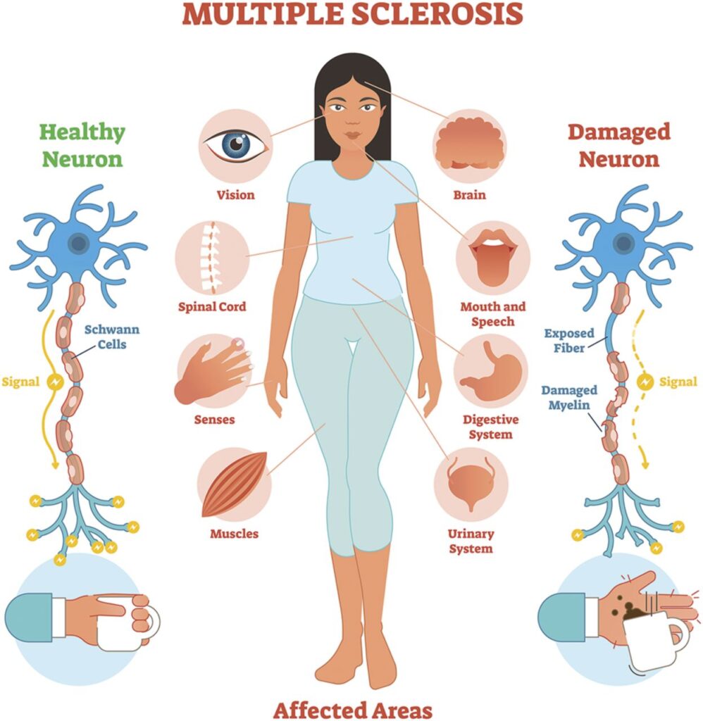 In the United States, around 1 million people are living with multiple sclerosis (MS). Of these, 80-85% of individuals diagnosed with MS have relapsing-remitting multiple sclerosis (RRMS), making it the most common subtype. RRMS is characterised by flare-ups or relapses, followed by periods of remission where symptoms improve or disappear entirely. While the exact cause of RRMS remains unclear, it is believed to be an autoimmune disorder where the immune system attacks the central nervous system (CNS), specifically the myelin sheath that protects nerve fibres. Given its high prevalence and the complex nature of the disease, researchers are emphasizing the development of high-quality, effective drugs to manage RRMS. Currently, available treatments are primarily aimed at reducing the frequency and severity of relapses, slowing disease progression, and managing symptoms. This blog post provides a comprehensive analysis of the Relapsing Remitting Multiple Sclerosis (RRMS) Drug Pipeline, offering insights into the latest drug developments, pipeline dynamics, trends, segmentation, market growth, and the impact of COVID-19 on the treatment landscape. Relapsing Remitting Multiple Sclerosis Drug Pipeline Analysis Overview The Relapsing Remitting Multiple Sclerosis Drug Pipeline encompasses therapies that are currently under development to manage RRMS. These therapies aim to modify the disease course, reduce inflammation, and promote remyelination — the process of repairing the damaged myelin sheath. The goal is to slow or halt disease progression, prevent relapses, and improve the quality of life for patients living with RRMS. Currently, disease-modifying therapies (DMTs) are the cornerstone of RRMS treatment. These include interferons, monoclonal antibodies, and oral therapies, which help reduce the frequency of relapses and slow the progression of the disease. However, there remains a significant unmet need for more effective treatments that offer better long-term efficacy, fewer side effects, and greater convenience for patients. As a result, the RRMS drug pipeline is rich with innovative approaches, including new drug classes and combination therapies. The pipeline also includes drugs that target the underlying mechanisms of RRMS, such as immune modulation, neuroprotection, and remyelination. In addition to DMTs, symptom management treatments are being explored to improve patient outcomes in areas like pain, fatigue, and mobility. Relapsing Remitting Multiple Sclerosis Drug Pipeline Dynamics Several key dynamics are shaping the RRMS Drug Pipeline. These dynamics include advancements in drug mechanisms, the development of targeted therapies, increasing knowledge of disease pathophysiology, and a growing understanding of patient needs. 1. Targeting the Immune System A central aspect of RRMS is the dysfunction of the immune system, which mistakenly attacks the protective myelin sheath around nerve fibres. The current pipeline of drugs is focusing on modulating the immune system to reduce its attacks on the CNS. The development of B-cell therapies, T-cell therapies, and anti-inflammatory monoclonal antibodies is aimed at either suppressing or modulating the immune response, which plays a key role in the progression of RRMS. 2. Neuroprotection and Remyelination Another dynamic is the exploration of therapies that promote neuroprotection (to protect nerve cells from damage) and remyelination (the repair of damaged myelin). These approaches aim to address the long-term consequences of RRMS, such as irreversible disability. Agents that promote remyelination are particularly promising as they could help restore lost function and improve long-term outcomes for patients. 3. Oral Therapies and Convenience Traditionally, RRMS treatments have been injectable or infused, which can be cumbersome and lead to patient non-compliance. As such, there is a shift toward the development of oral therapies that provide greater convenience and improve patient adherence. Oral medications like fingolimod (Gilenya) and dimethyl fumarate (Tecfidera) have paved the way for the development of new oral drugs, with several promising candidates currently in the pipeline. 4. Improved Safety Profiles One of the biggest challenges in treating RRMS is balancing efficacy with safety. Some of the existing DMTs can cause significant side effects, such as liver toxicity, infections, and increased risk of malignancy. Therefore, a significant focus of the drug pipeline is to develop drugs that maintain high efficacy while offering improved safety profiles. Newer treatments aim to minimise adverse effects through more targeted action or better patient monitoring. 5. Personalised Medicine Advances in genetic and biomarker research are allowing for more personalized approaches to MS treatment. By identifying genetic factors and specific biomarkers associated with the disease, researchers aim to develop therapies tailored to individual patients, increasing the likelihood of success and reducing the risk of side effects. External Relapsing Remitting Multiple Sclerosis Drug Pipeline Analysis Trends Several external trends are influencing the development of drugs for RRMS, including technological advancements, regulatory changes, and shifting patient needs. 1. Increased Investment in Research and Development There is a significant increase in the investment in R&D for RRMS treatments, driven by the growing unmet need for more effective therapies. Pharmaceutical companies, including large players and biotech firms, are focusing on novel drug classes, and there is increasing collaboration between academia, research institutions, and industry to accelerate innovation. 2. Focus on New Drug Classes There is a trend toward developing new classes of drugs for RRMS, such as S1P modulators, BTK inhibitors, and B-cell depleting agents. These novel therapies offer the potential for better targeting of disease mechanisms and more effective control of relapses and progression. 3. Regulatory Support Regulatory agencies like the FDA and EMA are offering accelerated approval pathways for promising MS treatments, including fast track and breakthrough designations. This support enables faster access to new therapies for patients in need and encourages pharmaceutical companies to invest in innovative solutions. 4. Patient-Centric Approach The increasing emphasis on patient-centric care is influencing the development of RRMS drugs. Patients are demanding treatments that not only offer better efficacy but also improved safety and convenience. This has led to a focus on developing oral drugs, as well as therapies that target both disease progression and symptom management. 5. Telemedicine and Digital Health With the rise of telemedicine and digital health tools, patients with RRMS can now more easily engage in remote monitoring, virtual consultations, and symptom tracking. These technologies are helping to personalise treatment plans and allow for more accurate assessments of treatment outcomes. Relapsing Remitting Multiple Sclerosis Drug Pipeline Segmentation The Relapsing Remitting Multiple Sclerosis Drug Pipeline can be segmented based on various factors, including drug class, stage of development, and patient demographics. Key segments include: 1. Drug Class Immunomodulatory Drugs: Including interferons, glatiramer acetate, and S1P modulators. Monoclonal Antibodies: Targeting specific immune system components like B-cells and T-cells. Oral Therapies: Including S1P modulators like fingolimod, and oral formulations of other drugs. Neuroprotective Agents: Focused on protecting nerve cells from damage and promoting myelin repair. Combination Therapies: Pairing immune modulators with other classes of drugs to improve efficacy and reduce side effects. 2. Stage of Development Preclinical: Early-stage drug development focused on discovering new molecules and validating mechanisms of action. Phase I: Safety trials involving a small number of healthy volunteers or patients. Phase II: Efficacy trials to assess the drug's ability to modify disease course and reduce relapses. Phase III: Large-scale clinical trials to confirm efficacy and safety in diverse patient populations. Approved: Drugs that have received regulatory approval for use in clinical practice. 3. Patient Demographics Adults: Drugs targeted at the most common age group for RRMS (typically between the ages of 20-40). Elderly: Treatment approaches for older patients, who may have comorbidities and different drug tolerances. Pediatrics: Although rare, RRMS can also affect children, leading to the development of age-appropriate therapies. Relapsing Remitting Multiple Sclerosis Drug Pipeline Growth The growth of the RRMS drug pipeline has been remarkable in recent years. Advances in drug development, combined with increasing understanding of the disease’s mechanisms, are leading to the creation of more potent and targeted treatments. Several factors contribute to this growth: Unmet Medical Need: Despite the availability of existing treatments, many patients still experience breakthrough relapses and disease progression. This has created a strong demand for new, more effective therapies. Advances in Immunology: A deeper understanding of the immune system's role in MS is enabling the development of drugs that can more precisely target immune dysfunction. Regulatory Pathways: Accelerated approval processes are helping bring new drugs to market faster, improving the outlook for future therapies. Collaborative Research: Increasing collaboration between pharmaceutical companies, universities, and research institutions is fostering innovation and speedier drug development. Recent Relapsing Remitting Multiple Sclerosis Drug Pipeline Market The RRMS drug pipeline market is expanding rapidly, with several promising drugs nearing approval. Companies such as Celgene, Hoffmann-La Roche, and Hikma Pharmaceuticals are leading the way, with multiple drugs in clinical trials aimed at improving treatment options. The market for RRMS therapies is expected to grow significantly as new treatments enter the market and as more patients seek out effective solutions. Relapsing Remitting Multiple Sclerosis Drug Pipeline Scope The scope of the RRMS drug pipeline extends far beyond the development of traditional disease-modifying therapies. With the focus on immunology, remyelination, and neuroprotection, the scope of treatments is broadening to include therapies that target various aspects of the disease, improving both short-term and long-term outcomes for patients. Relapsing Remitting Multiple Sclerosis Drug Pipeline Analysis The RRMS drug pipeline analysis indicates an exciting future for patients with relapsing-remitting multiple sclerosis. As researchers continue to innovate and explore new approaches to treatment, patients will benefit from a wider range of effective therapies. COVID-19 Impact Analysis The COVID-19 pandemic has had a mixed impact on the RRMS drug pipeline. On one hand, it slowed some clinical trials due to restrictions on in-person visits and resources being redirected toward COVID-19 treatments. On the other hand, the pandemic has highlighted the need for innovative therapies, pushing the development of oral treatments, digital health tools, and more effective disease-modifying therapies for autoimmune diseases. Key Players in the RRMS Drug Pipeline Celgene: Known for its work in autoimmune diseases and its development of ozanimod, a promising S1P receptor modulator for RRMS. Hoffmann-La Roche: Leader in the development of Ocrevus (ocrelizumab), a monoclonal antibody that has shown efficacy in RRMS treatment. Hikma Pharmaceuticals: Known for developing oral therapies and treatments that could provide more convenience for RRMS patients. FAQ 1. What is relapsing-remitting multiple sclerosis? RRMS is the most common form of multiple sclerosis, characterised by periods of relapse followed by remissions where symptoms improve or disappear. 2. How is RRMS treated? RRMS is typically treated with disease-modifying therapies (DMTs), such as immunomodulators, monoclonal antibodies, and oral medications. 3. What are the latest trends in RRMS drug development? Current trends include developing targeted therapies, oral drugs, and drugs that promote neuroprotection and remyelination. 4. Who are the key players in the RRMS drug pipeline? Key players include Celgene, Hoffmann-La Roche, and Hikma Pharmaceuticals, all of which are developing innovative therapies for RRMS. 5. What is the impact of COVID-19 on RRMS treatment development? COVID-19 has accelerated the development of oral treatments and digital health tools but has also slowed clinical trials due to resource limitations.