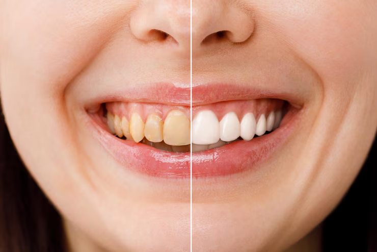 Teeth Whitening pittsburgh pa