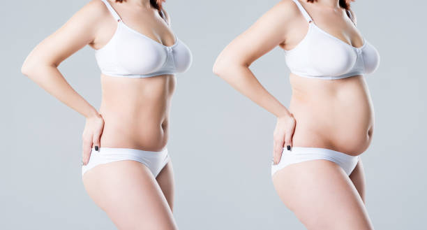 Tummy Tuck Surgery in Riyadh