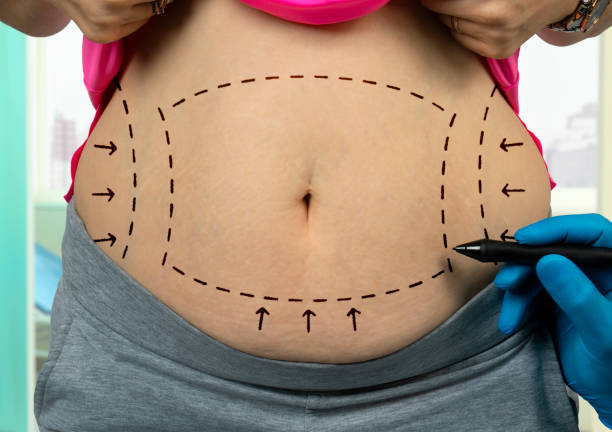 Tummy Tuck Surgery in Riyadh