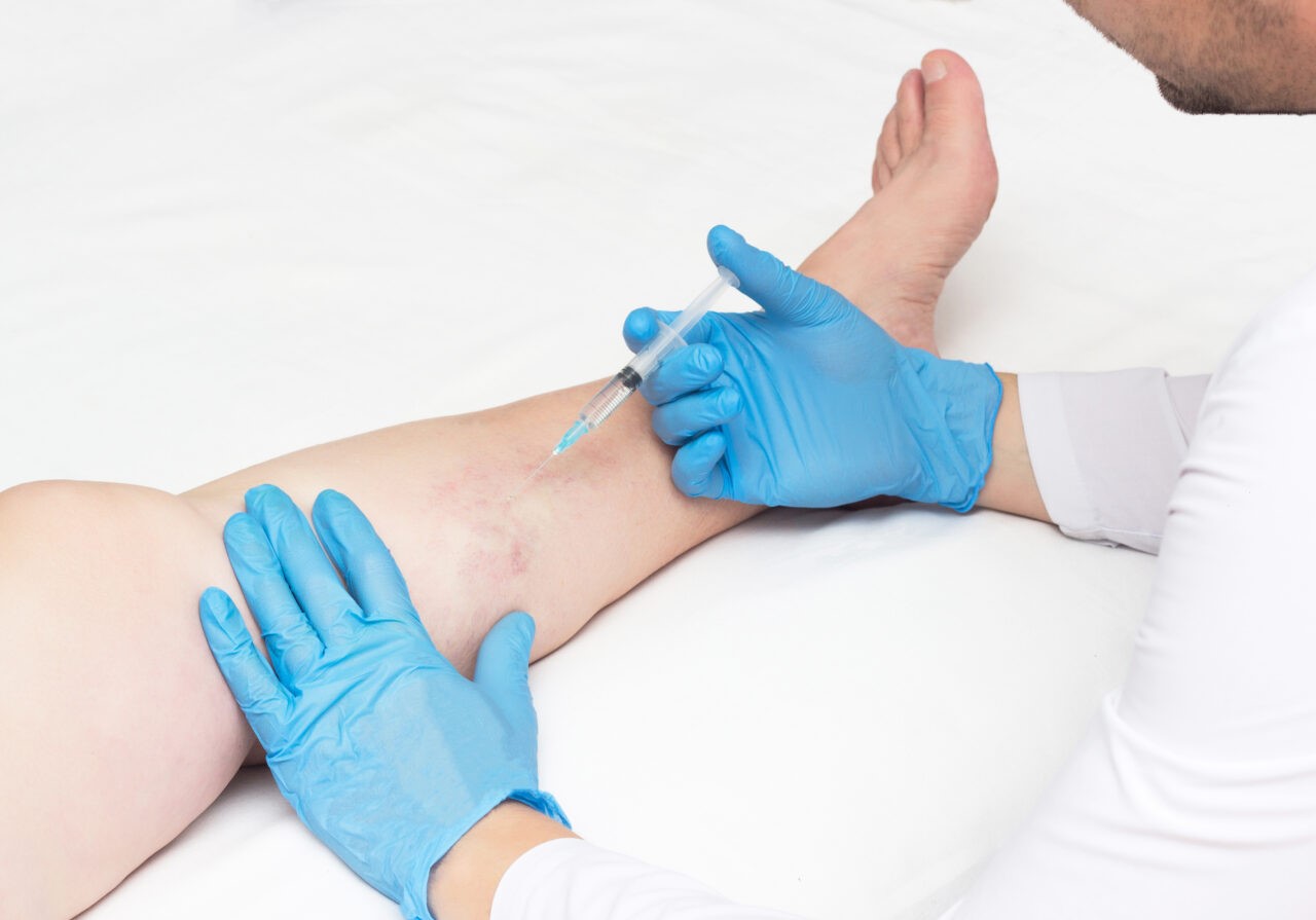 How Much Does Varicose Vein Treatment Cost