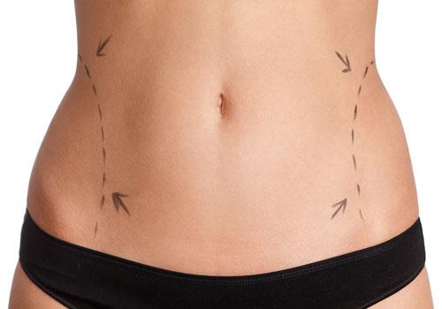 Liposuction Surgery in Dubai