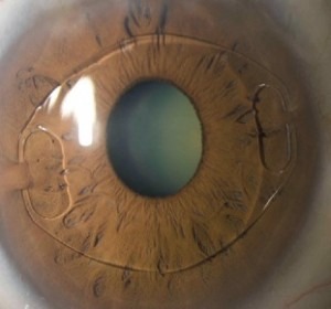 implantable contact lens surgery