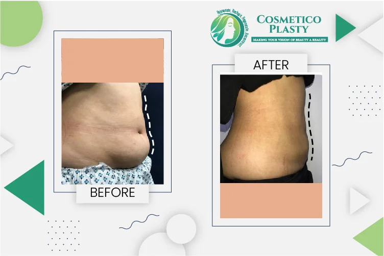 Liposuction Cost in Pakistan