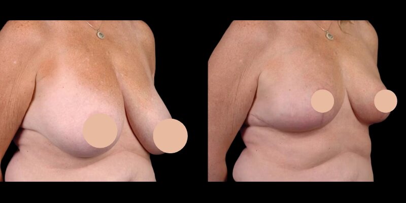 breast reduction in dubai