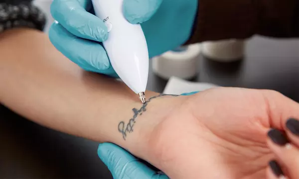 Why Laser Tattoo Removal is the Best Option