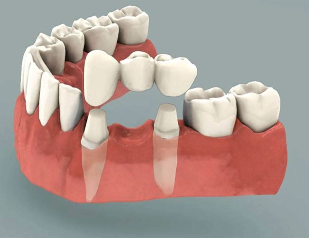 restorative dentistry in Boise, Idaho